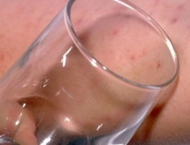 Μηνιγγίτιδα- Σημάδι στο δέρμα: Πώς γίνεται επιτόπου το “τεστ με το ποτήρι” (βίντεο-φωτο)